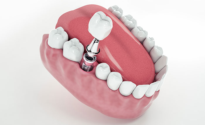 インプラントによる治療